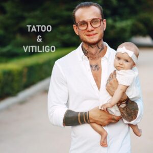 витилиго татуировки